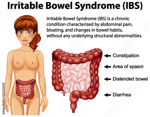 Irritable Bowel Syndrome (IBS) Infographic