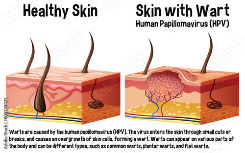 Healthy skin and skin with wart infographic with explanation