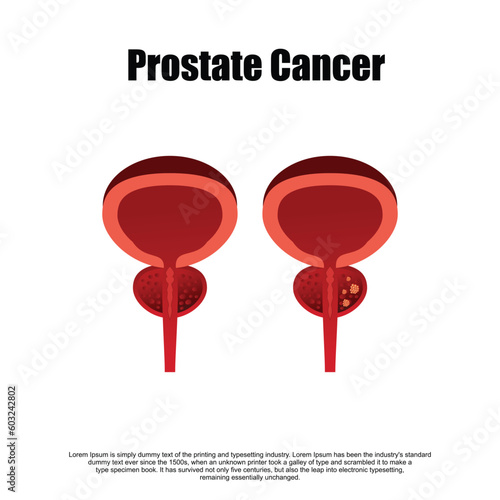 Prostatitis normal and inflamed prostate isolated vector