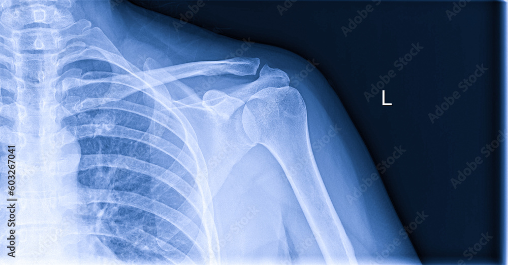 X-ray image of shoulder pain, shoulder ligament tendinitis, shoulder muscle strain - obrazy, fototapety, plakaty 