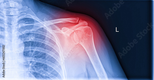 X-ray image of shoulder pain, shoulder ligament tendinitis, shoulder muscle strain photo