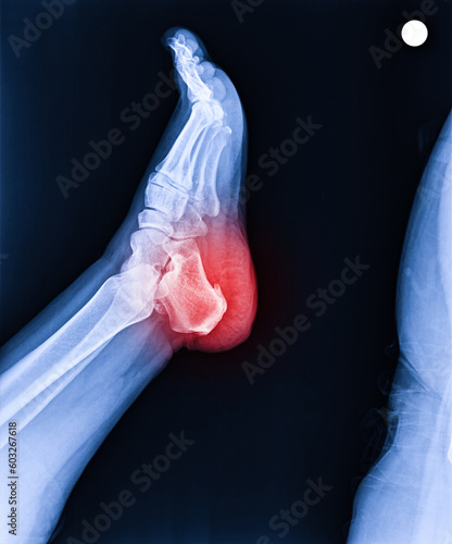 Foot and ankle pain on x-ray, isolated on black background, heel pain, heel spur photo