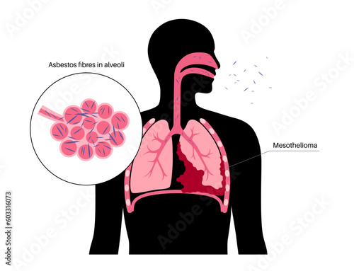 Mesothelioma cancer disease