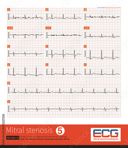 Female, 55 years old, diagnosed with mitral stenosis 5 years ago. When this ECG was taken, the patient still maintained sinus rhythm.Note that the P wave duration was widened.