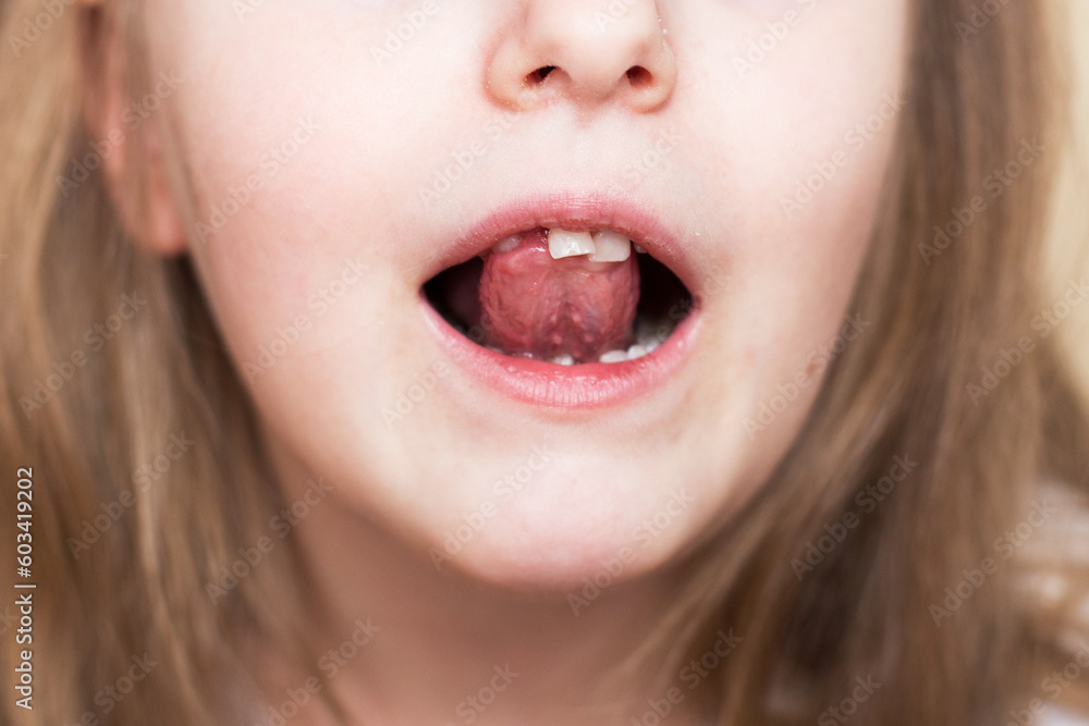portrait of a little child girl moving her milk front tooth with her tongue in open mouth. portrait of a little child girl moving her milk front tooth with her tongue in open mouth.
