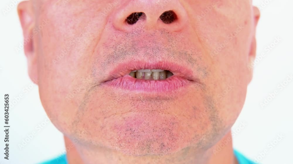 closeup oral cavity of patient, charismatic mature man 60 years old open mouth, shows teeth with temporary fillings and metal, titanium pins for prosthetics or splinting, anesthesia for prosthetics closeup oral cavity of patient, charismatic mature man 60 years old open mouth, shows teeth with temporary fillings and metal, titanium pins for prosthetics or splinting, anesthesia for prosthetics