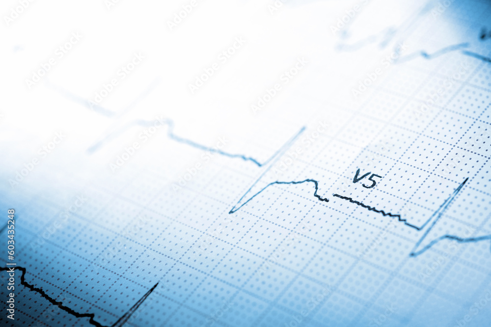 Close-up of an electrocardiogram printed on blue paper.