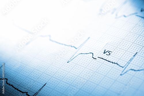 Close-up of an electrocardiogram printed on blue paper.