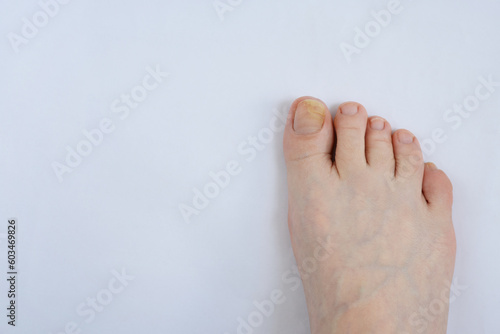 Toenails affected by fungal infection. Onychomycosis