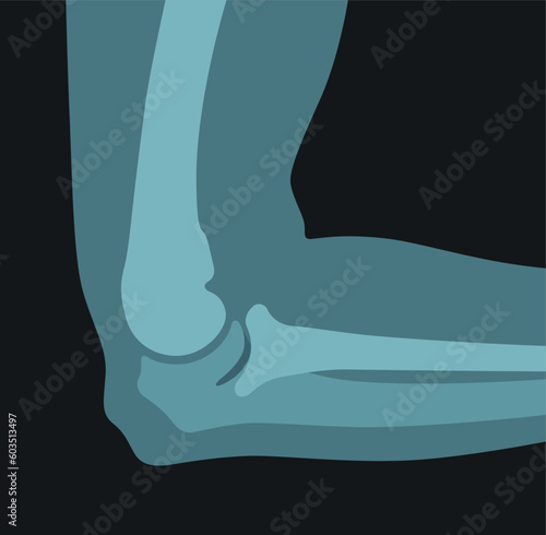 X ray of human elbow screen scan image for clinic medical radiology research vector flat