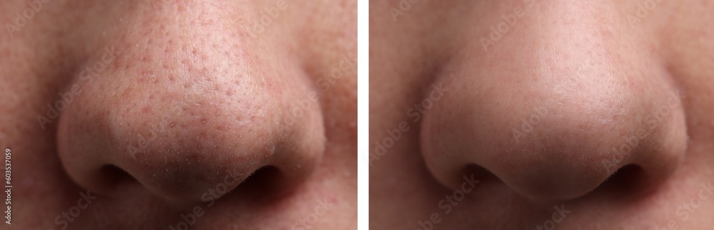 Fototapeta premium Photos of man before and after acne treatment, closeup. Collage showing affected and healthy skin