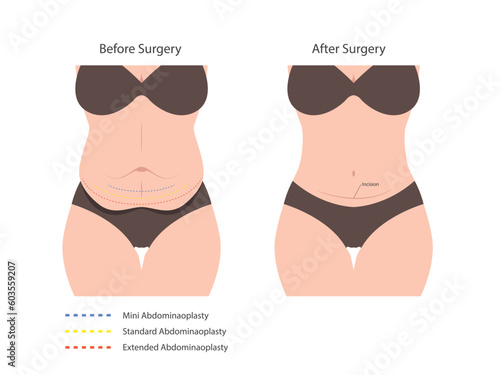 Abdominoplasty tummy tuck surgery. skin fat loss photo