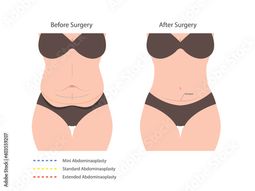 Abdominoplasty tummy tuck surgery. skin fat loss