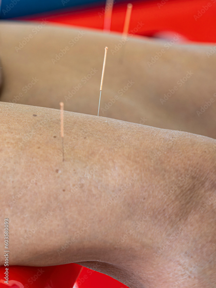 Traditional Chinese acupuncture is where acupuncture is applied to the patient's skin. Traditional Chinese acupuncture is where acupuncture is applied to the patient's skin.
