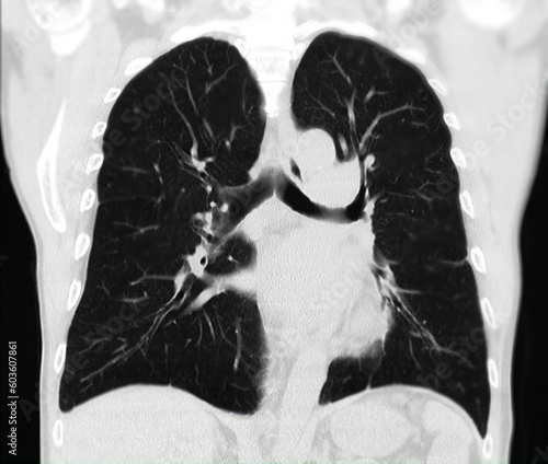 Foto CT scan of Chest or lung for screening lung nodules and lung cancer