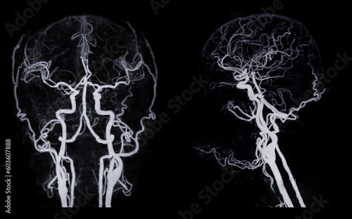 CT angiography of the brain or CTA brain showing Cerebral aryery.