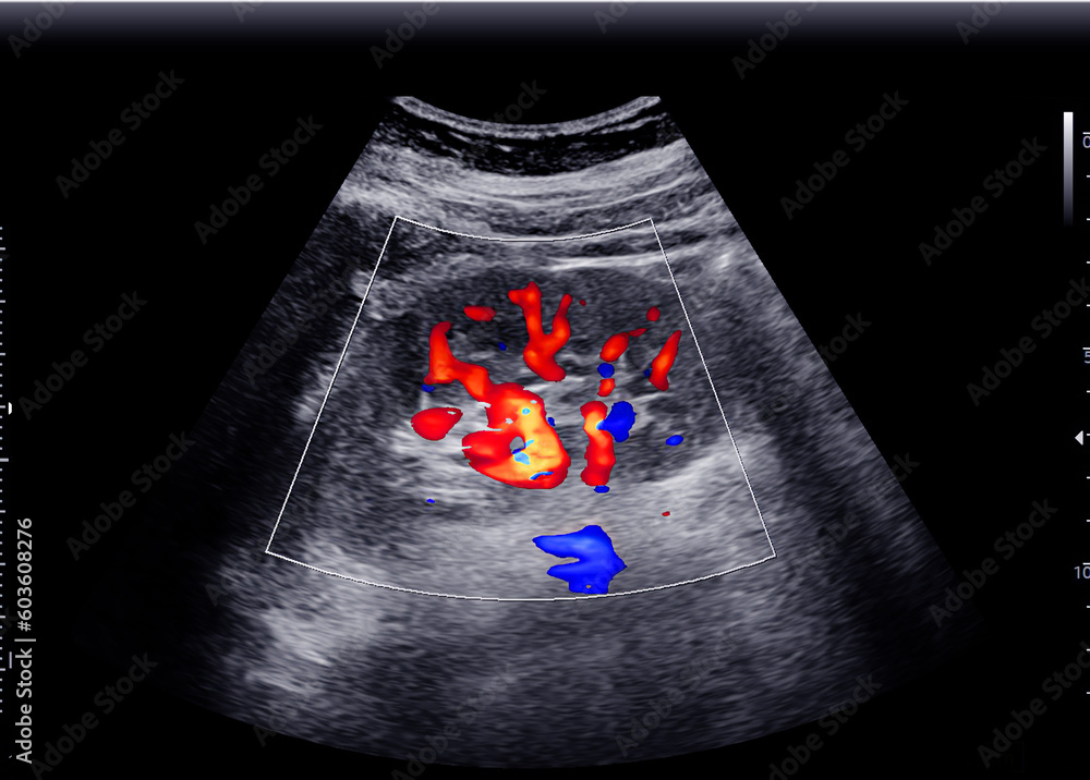 Ultrasound of Kidney or KUB for screening renal stone disease. Stock