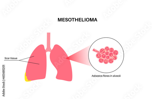 Mesothelioma cancer disease