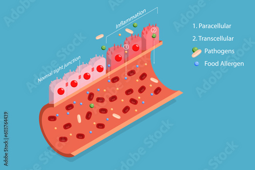 3D Isometric Flat Vector Conceptual Illustration of Leaky Gut Syndrome, Autoimmune Disorder