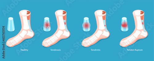 3D Isometric Flat Vector Conceptual Illustration of Achilles Tendon, Tendinitis Problem photo