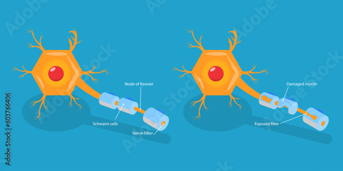 3D Isometric Flat Vector Conceptual Illustration of Multiple Sclerosis, Demyelinating Disease