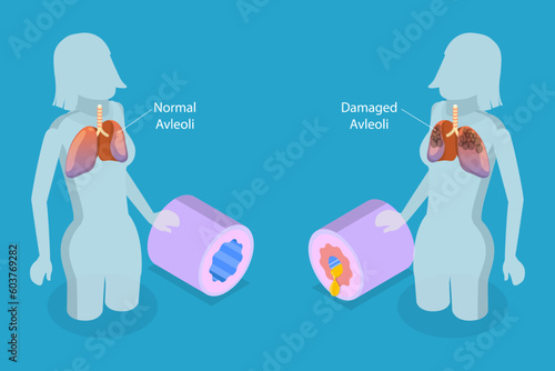 3D Isometric Flat Vector Conceptual Illustration of Chronic Obstructive Pulmonary Disease , COPD
