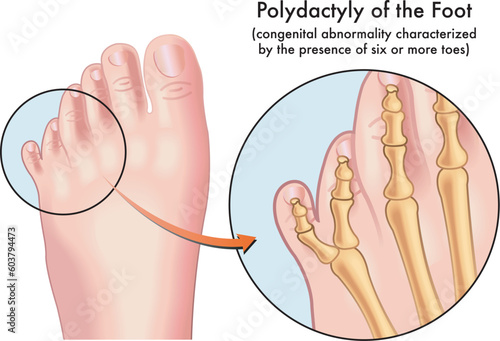 Medical illustration of a foot afflicted with Polydactyly, a congenital abnormality characterized by the presence of six or more toes, with annotations.