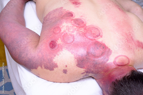 hemangioma of the skin on the back of an adult man, when massaged with cans photo