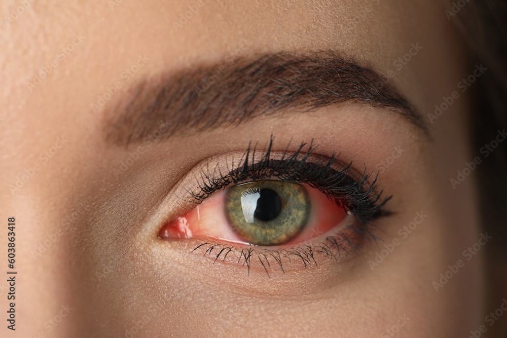 Fototapeta premium Woman suffering from conjunctivitis, closeup of red eye