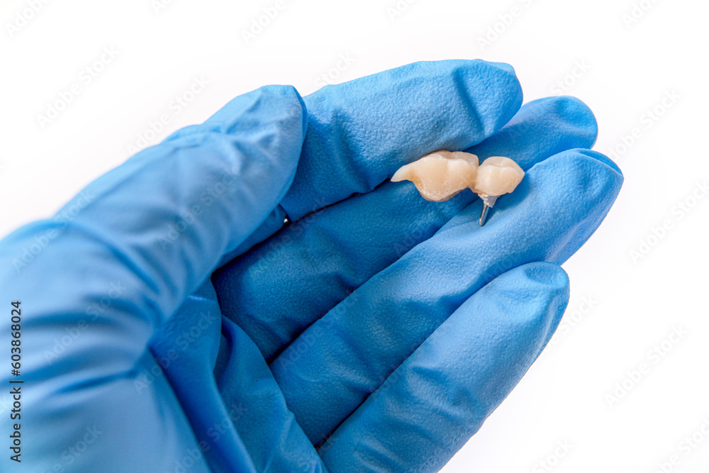 broken dental bridge in dentist's hand