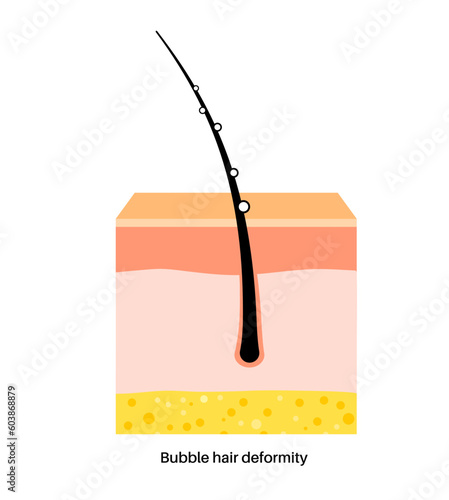 Bubble hair deformity