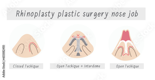 Rhinoplasty plastic surgery nose job, Rhinoplasty surgery vector
