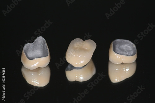 Macro shot of crowns. Dental PFM (non precious) with all porcelain baked.