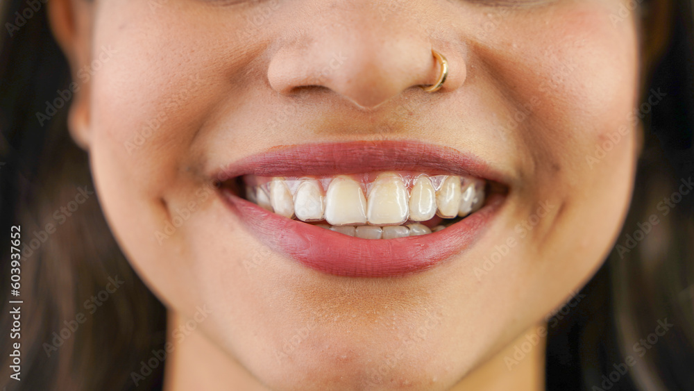 Young Asian Indian woman holding removable invisible aligner, also known as invisalign or clear aligner Young Asian Indian woman holding removable invisible aligner, also known as invisalign or clear aligner
