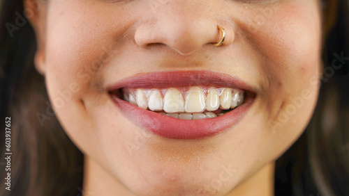 Young Asian Indian woman holding removable invisible aligner, also known as invisalign or  clear aligner