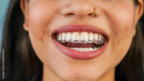Young Asian Indian woman holding removable invisible aligner  also known as invisalign or  clear aligner