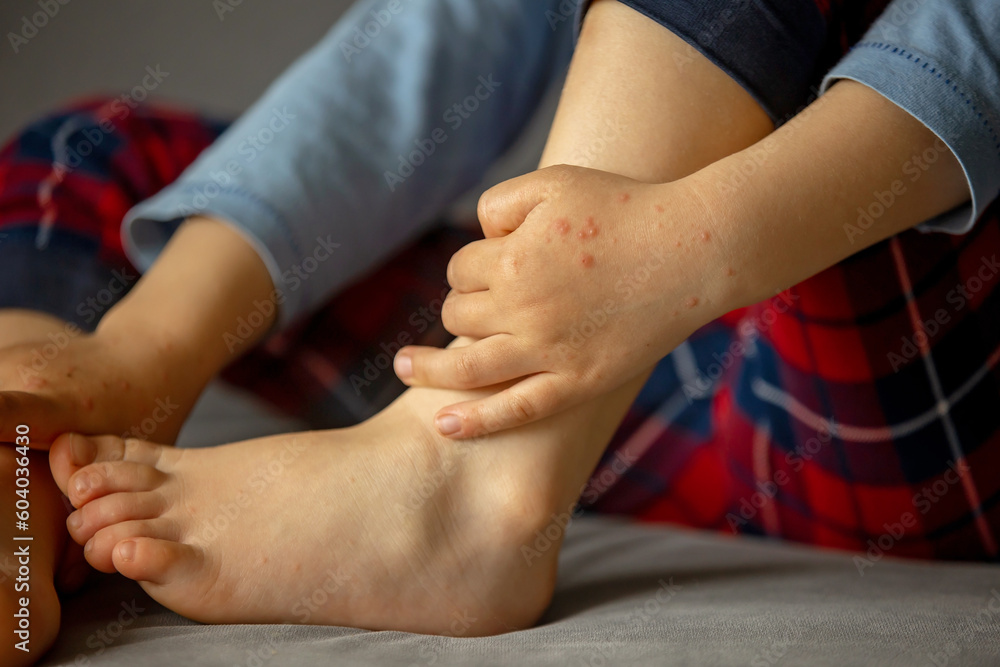 Child with skin rash, roseola. Handfootandmouth disease. Enterovirus Leg arm mouth Rash on