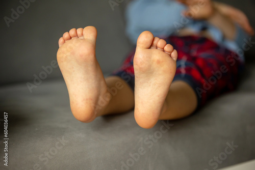 Child with skin rash, roseola. Hand-foot-and-mouth disease. Enterovirus Leg arm mouth Rash on  child. Cocksackie virus photo