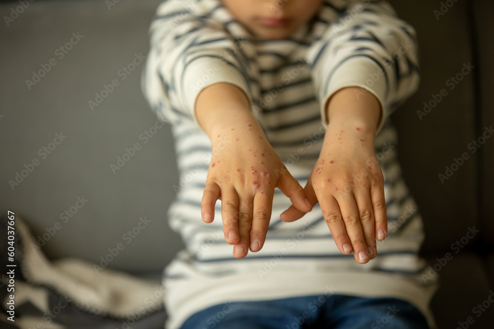 Child with skin rash, roseola. Handfootandmouth disease. Enterovirus Leg arm mouth Rash on