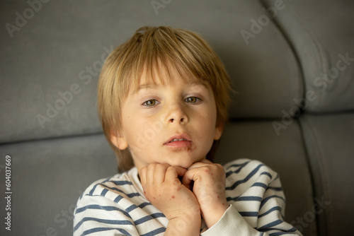 Child with skin rash, roseola. Hand-foot-and-mouth disease. Enterovirus Leg arm mouth Rash on  child. Cocksackie virus photo