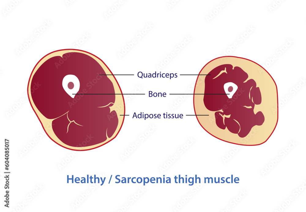 Infographic of healthy and sarcopenia thigh muscle vector illustration