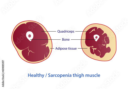 Infographic of healthy and sarcopenia thigh muscle vector illustration isolated on white background. Cross section of strength and losing muscle mass. Anatomy and health care concept illustration.