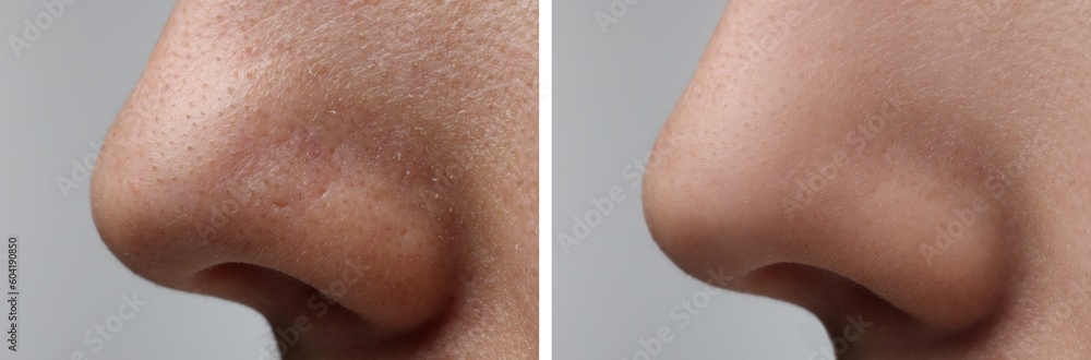 Fototapeta premium Before and after acne treatment. Photos of woman on grey background, closeup. Collage showing affected and healthy skin
