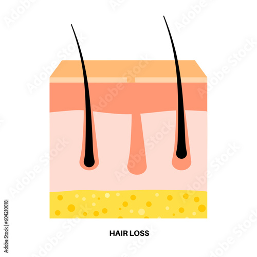 Hair loss pattern