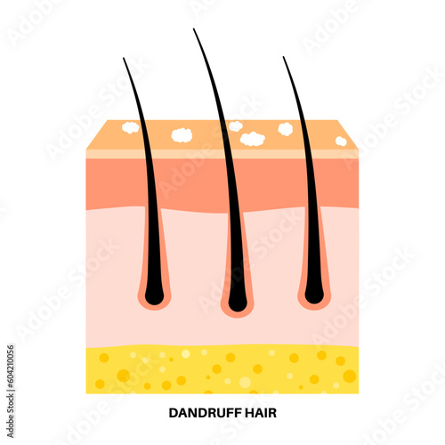Dandruff hair poster