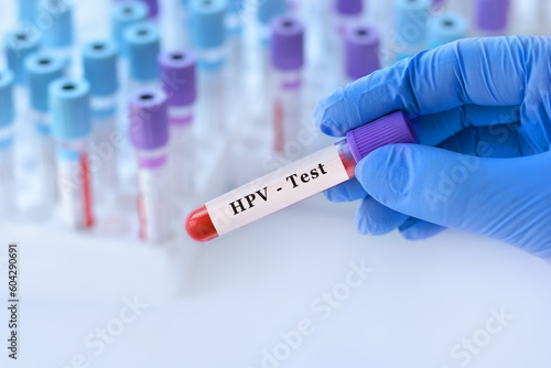 Doctor holding a test blood sample tube with HPV test on the background of medical test tubes with analyzes. photo