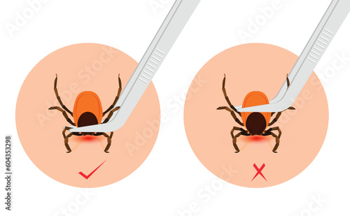 Removing encephalitis ticks after bite. How to remove mite. Parasite carrying disease. Tick grabbed into skin, it is removed with tweezers.