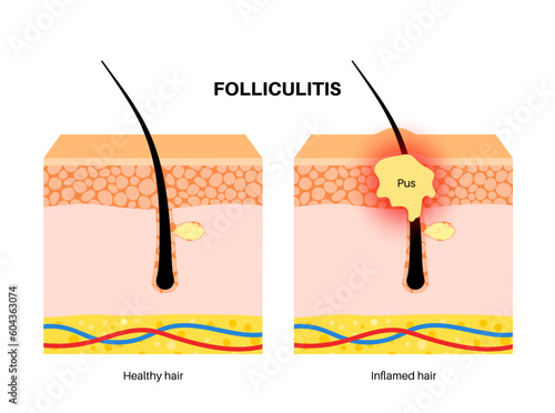 Folliculitis in skin layers
