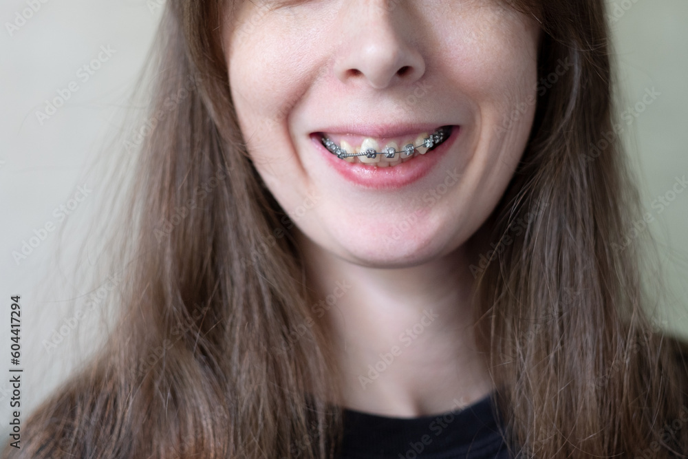 Woman's smile with dental braces to correct an overbite close-up. Correcting crooked teeth with iron braces Woman's smile with dental braces to correct an overbite close-up. Correcting crooked teeth with iron braces