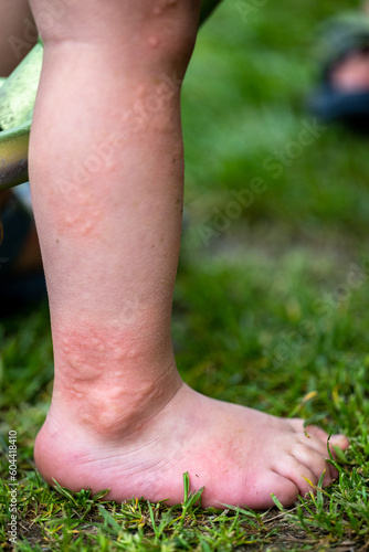 Close-up of a child's leg with stinging nettle blisters.